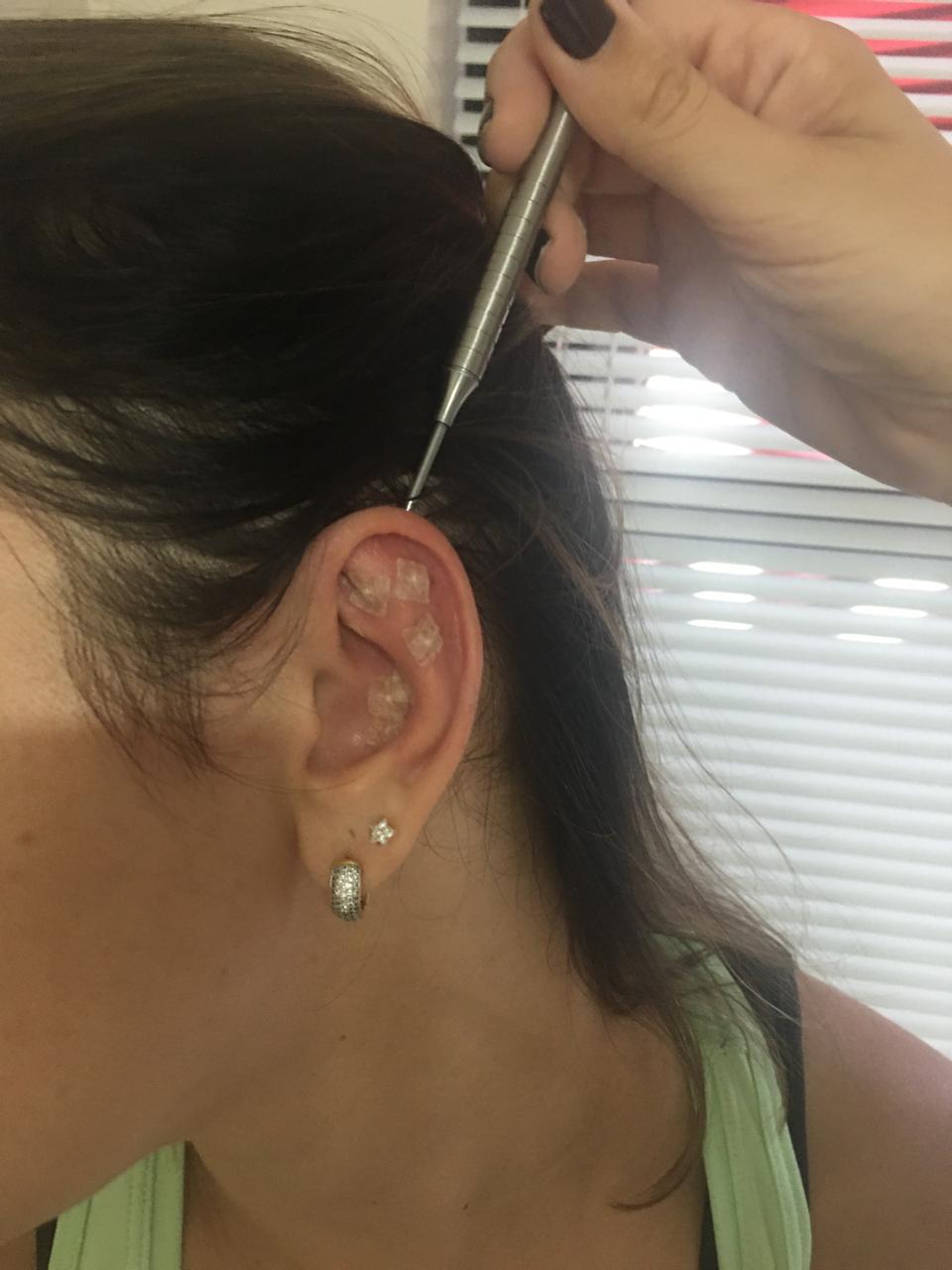 Auriculoterapia